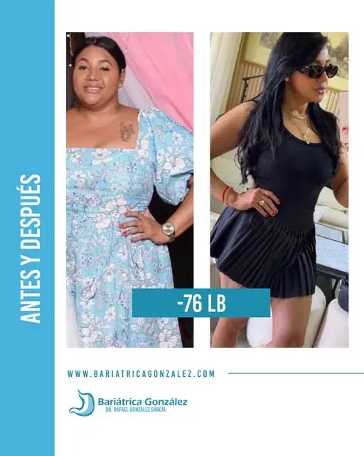 Antes y después de una paciente de Bariátrica González que perdió 76 libras